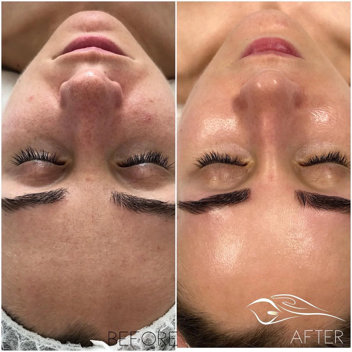 Between the sun and the dry climate here in LA, it's no wonder skin can look dull and lifeless. Thankfully we have the HydraFacial to help bring our skin back to health!

The HydraFacial is an invigorating treatment that is good for hyperpigmentation