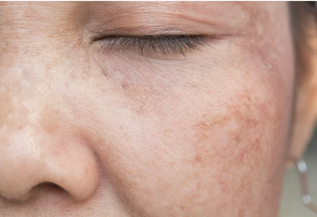How to Get Rid of Hyperpigmentation 