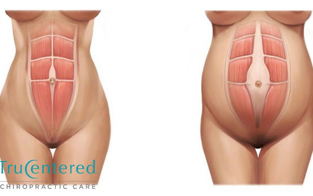 Diastasis Recti What you need to know Sweaty as a Mother