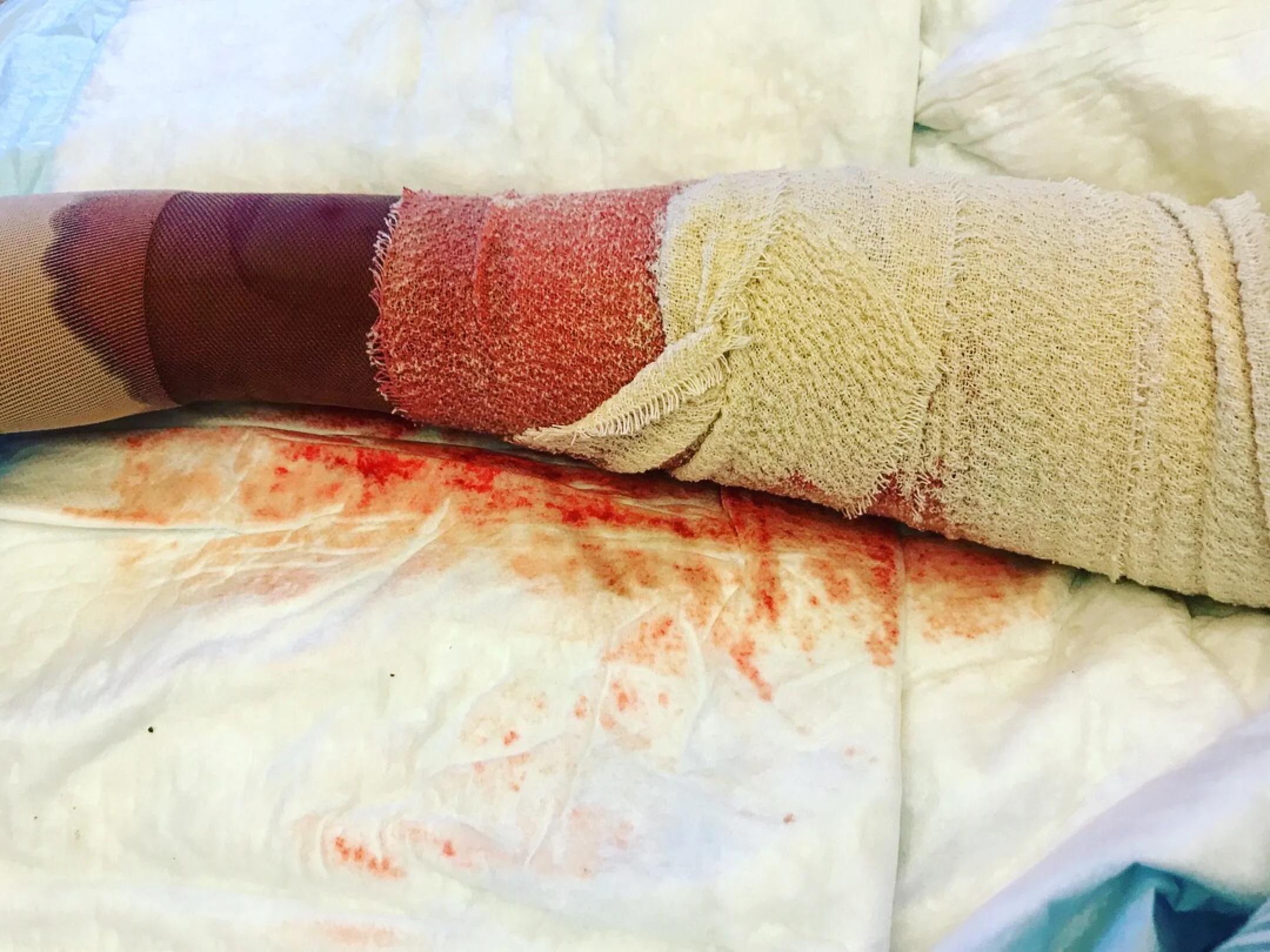 The 6th & 7th; She removed a whole litre of fat.