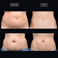 Contour light stomach pic.jpg