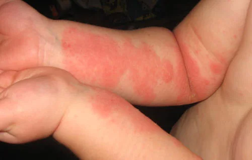 Childhood eczema