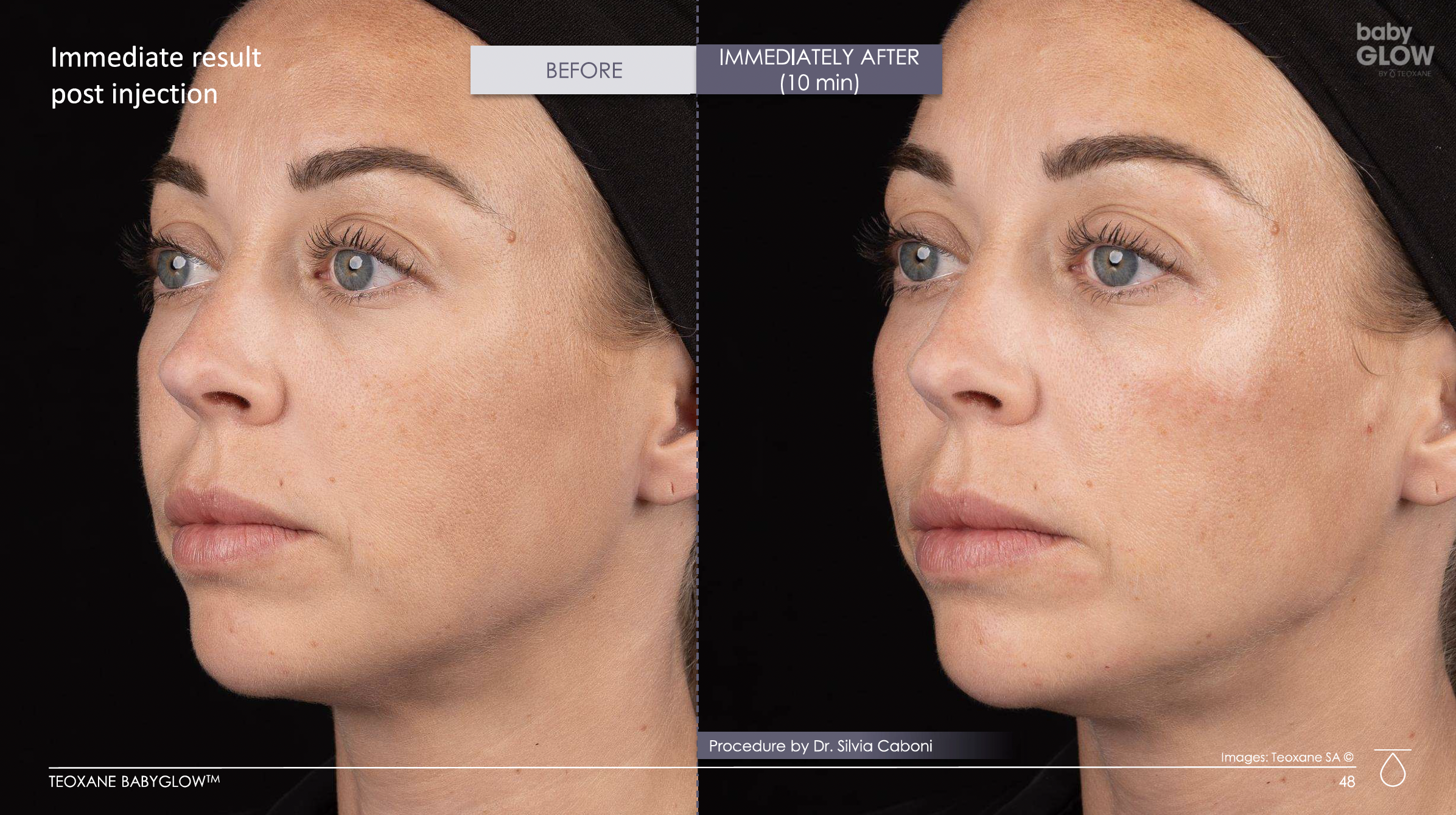 Side-by-side before-and-after photos showing the immediate facial skin rejuvenation results 10 minutes after treatment, with visibly smoother, more hydrated-looking skin.