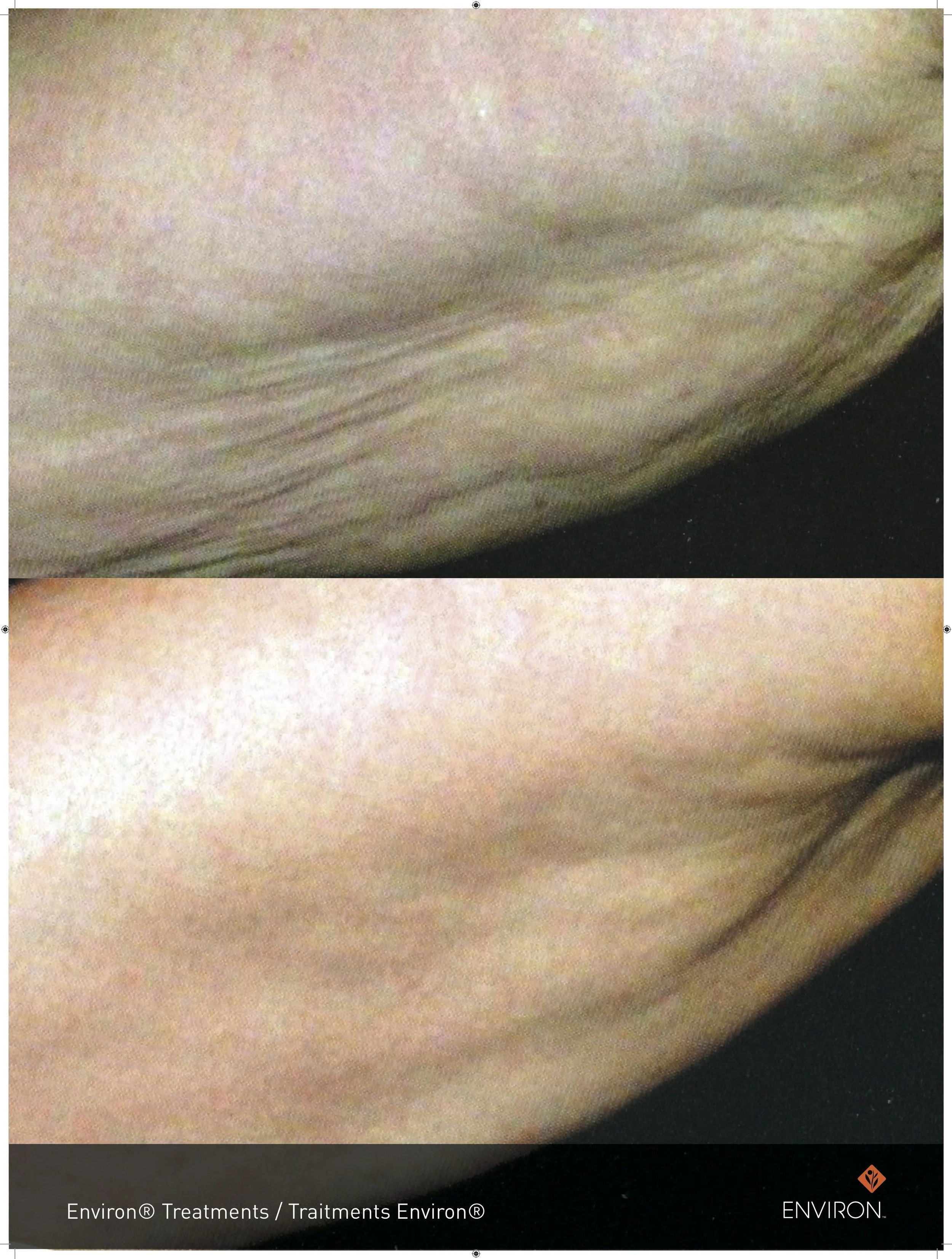 before and after with body treatments utilizing body profile infusions for skin tightening