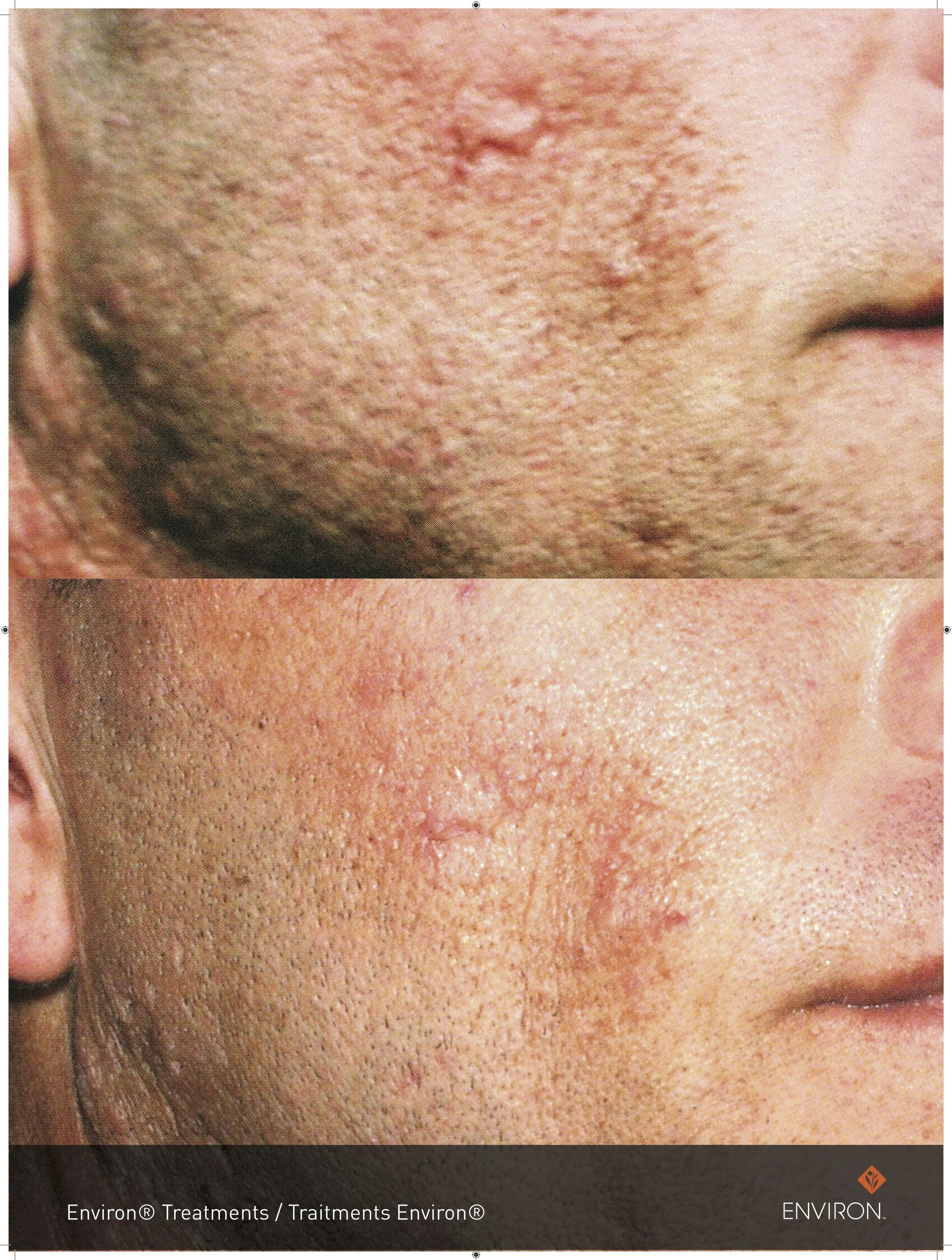before and after with cool peel treatments and vitamin a infusions