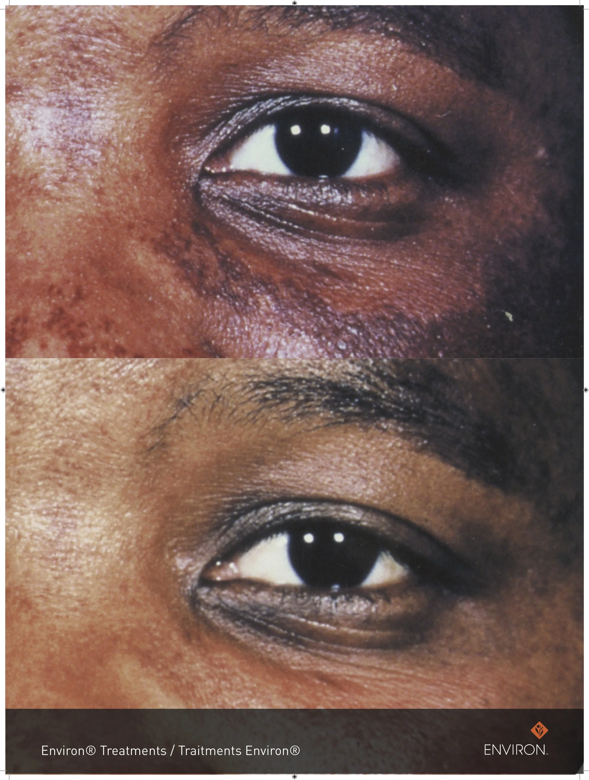 before and after with vitamin infusion treatments and vita-peptide eye gel