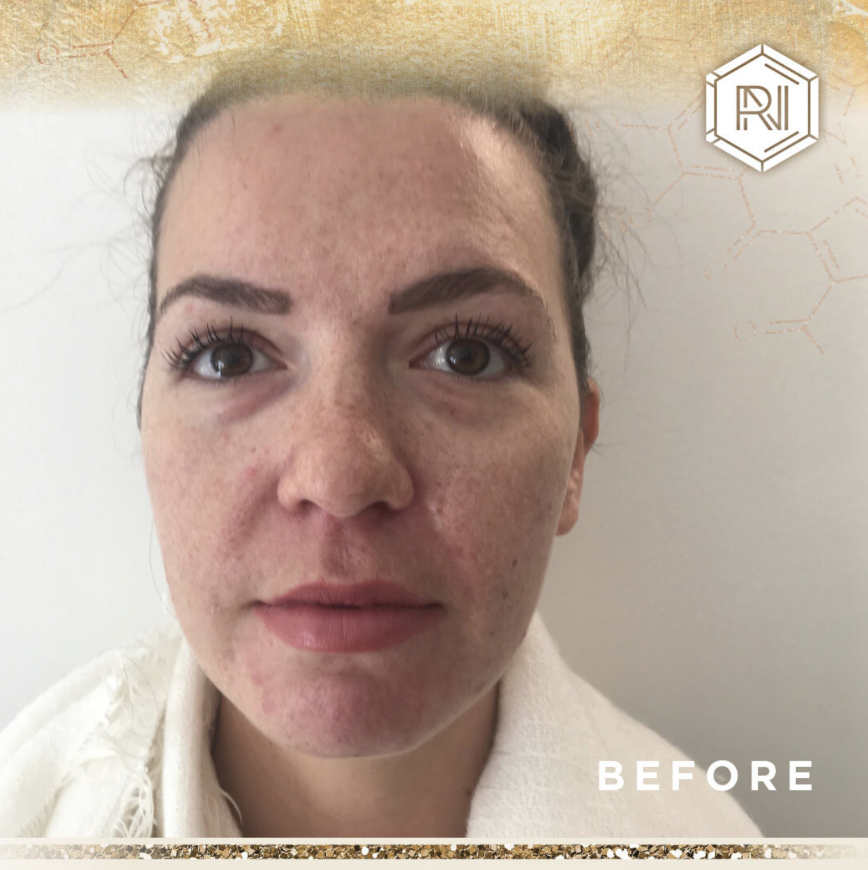 Skin RNI Canmore Before and After