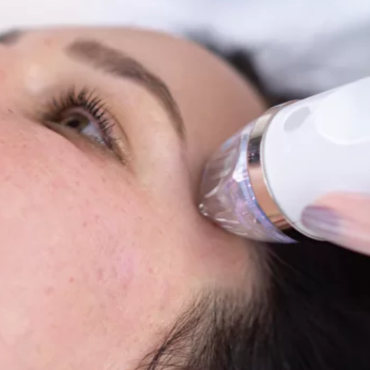 RF Microneedling