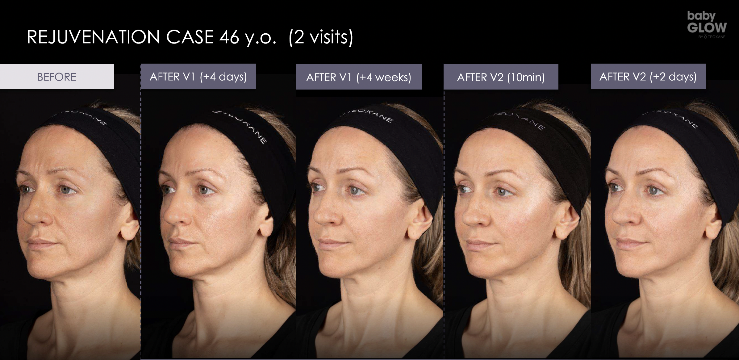 Before-and-after photos showing facial skin rejuvenation results in a 46-year-old woman over two treatment visits, from before treatment through four weeks after the first visit and two days after the second.