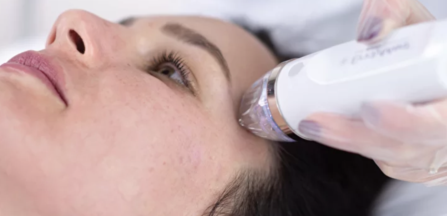 Lady getting RF micro needling in Canmore at Skin RNI