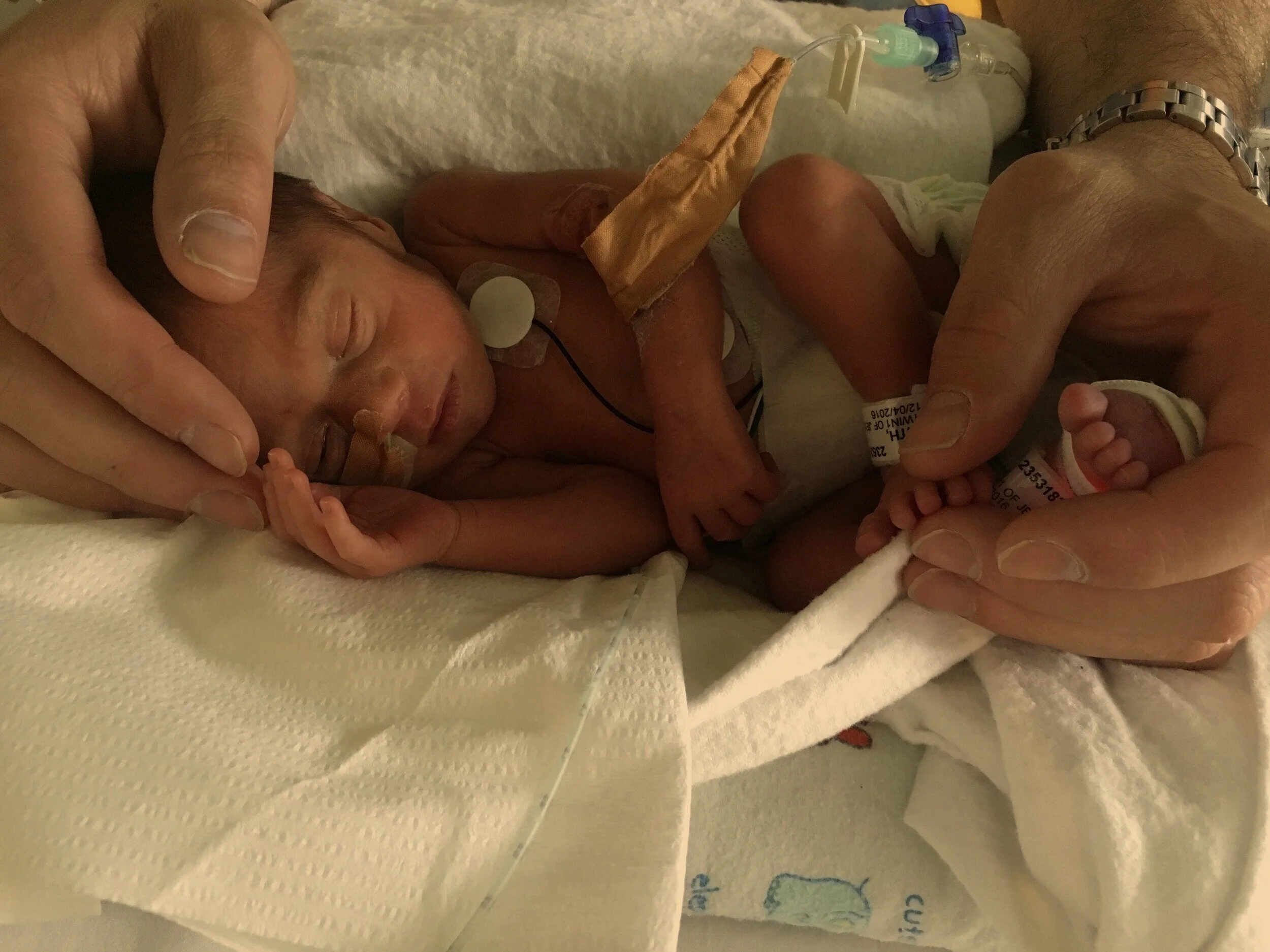 Twin Pregnancy Premature Twins 24 Weeks Twin Babies 36 Week