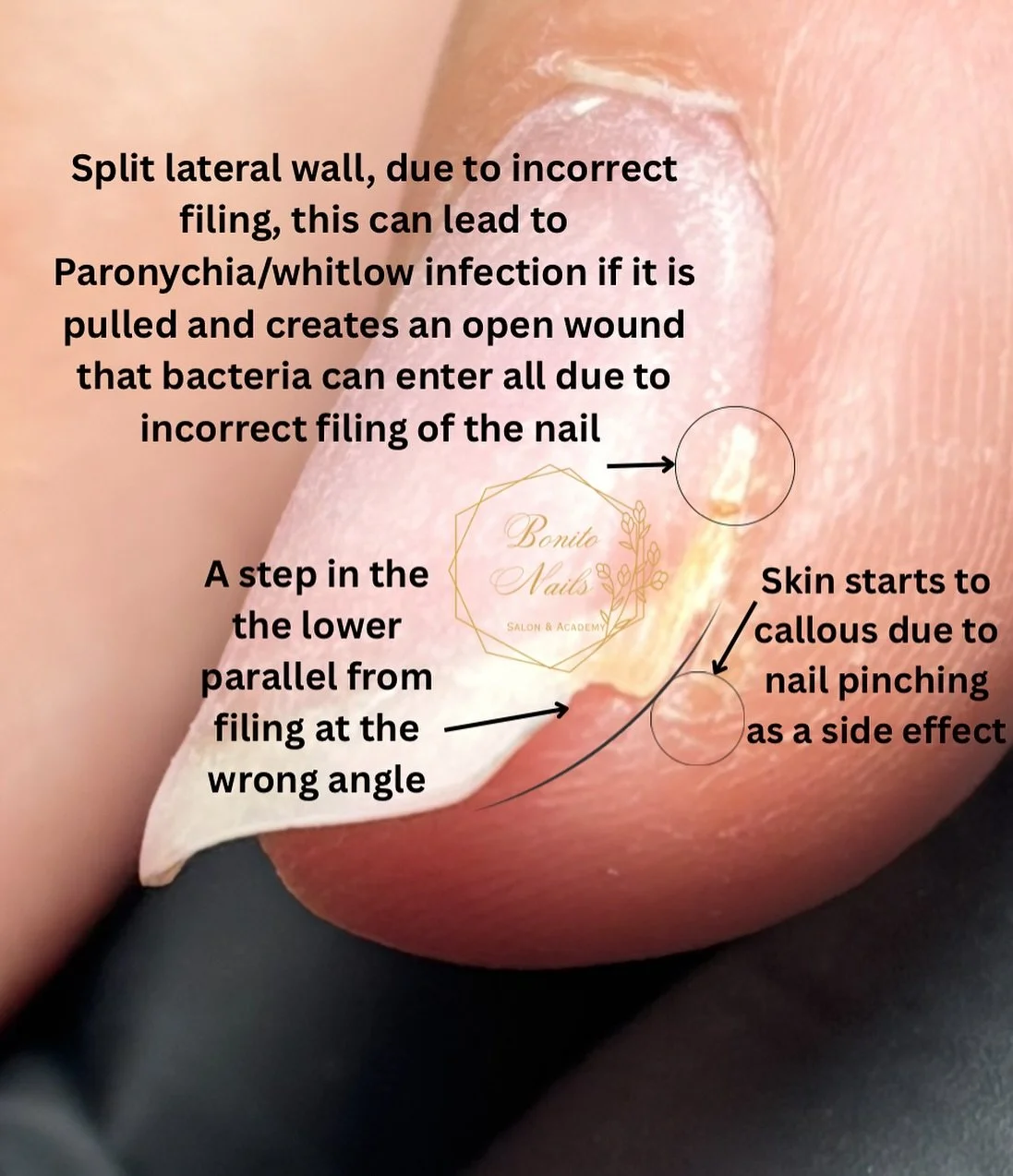 Tutorial Tuesday again 😁
Filing nails correctly is so important as incorrect shaping can have a knock on effect on nail growth. 

This client wasn&rsquo;t aware that these side callouses and nail pinching was a side effect of incorrect filing from h