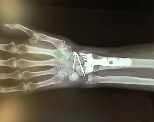 Hand x-ray