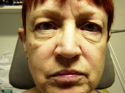 Facelift-Eyelid-FatStem-Cell-Before-front-400x3001.jpg