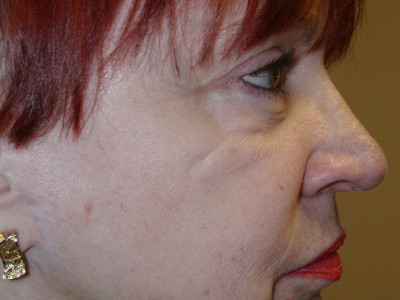 Facelift-Eyelid-FatStem-Cell-after-side1-400x300.jpg