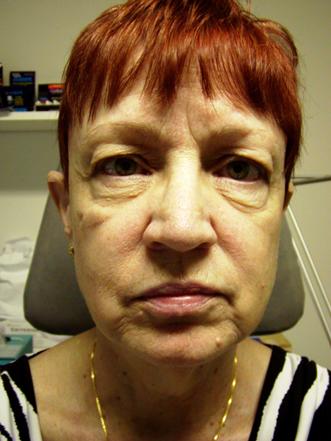 Facelift-Eyelid-FatStem-Cell-Before-front.jpg