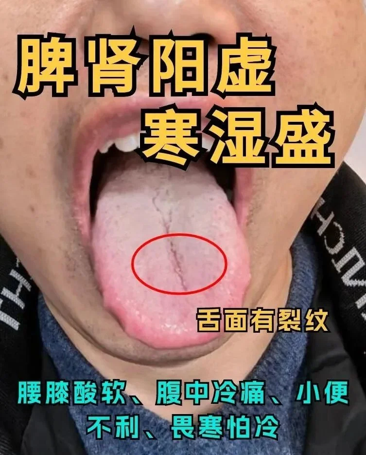 阳虚寒湿的舌象