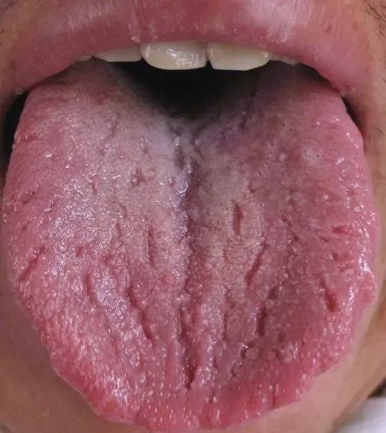 The tongue image of yin deficiency presents with many deep cracks on the tongue surface