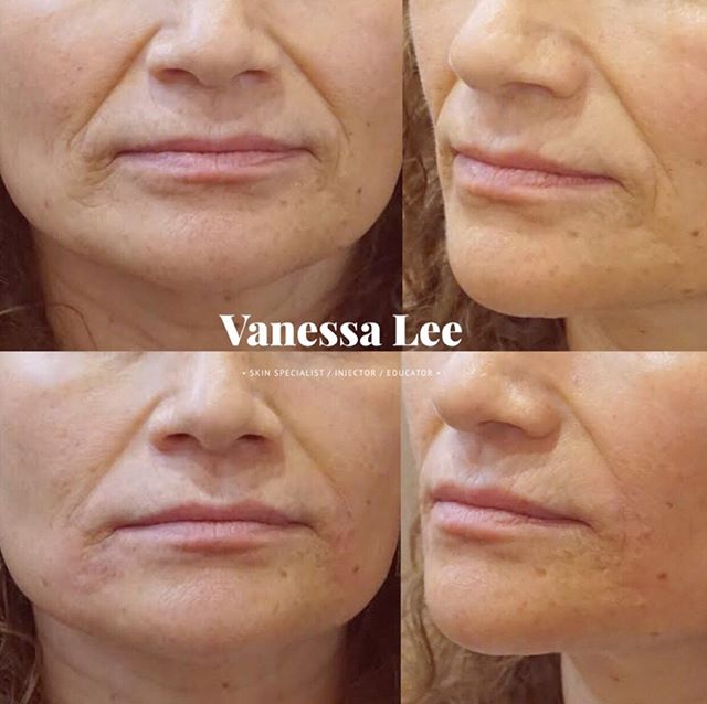 This client used to unconsciously rest her face in a frowning position. She also smiled in a downward pull. Her concentration face also involved frowning. So naturally over years the skin around the corners of her mouth became worn down and deep line