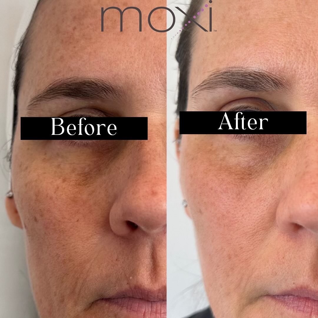 Want to look your best but don&rsquo;t know where to begin? Moxi is Sciton&rsquo;s newest fractionated laser for revitalized skin.  Moxi reduces pigment and improves the skin&rsquo;s overall tone and texture. The treatment is perfect if you&rsquo;re 
