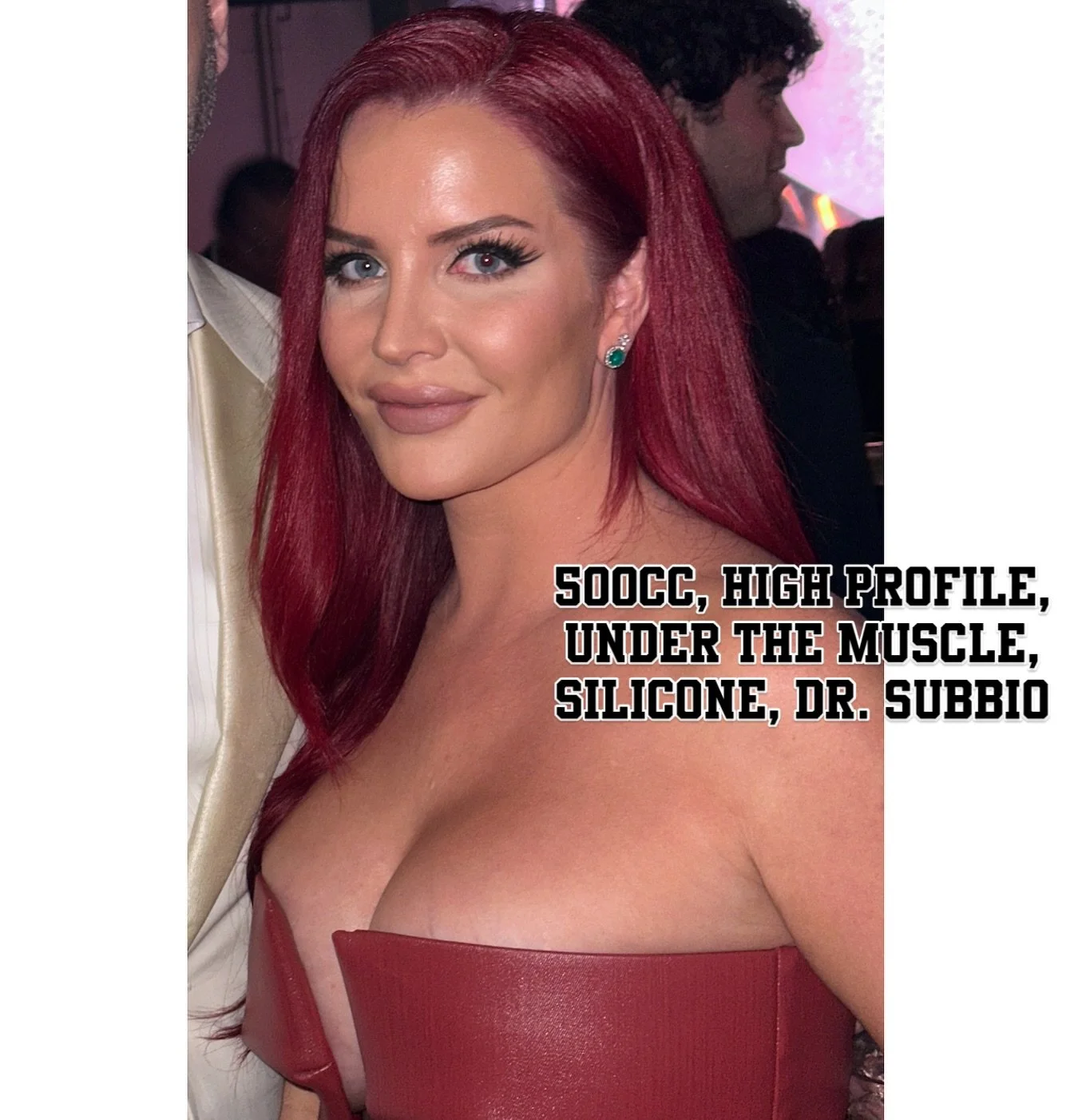 Jumping on the trend, loving this age of transparency. 💪🏻💪🏻 @dr.subbio

500cc after getting reduced from 800cc&hellip; so glad those ones are out!!!!

Rhinoplasty by Dr. Andrew Miller @realdrface 
Lipo 360 with an athletic BBL by Dr. Ryan Neinste