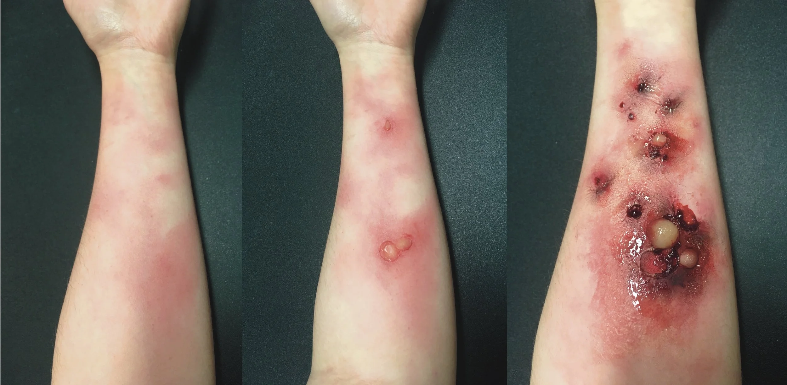  1st, 2nd, and 3rd degree burn 