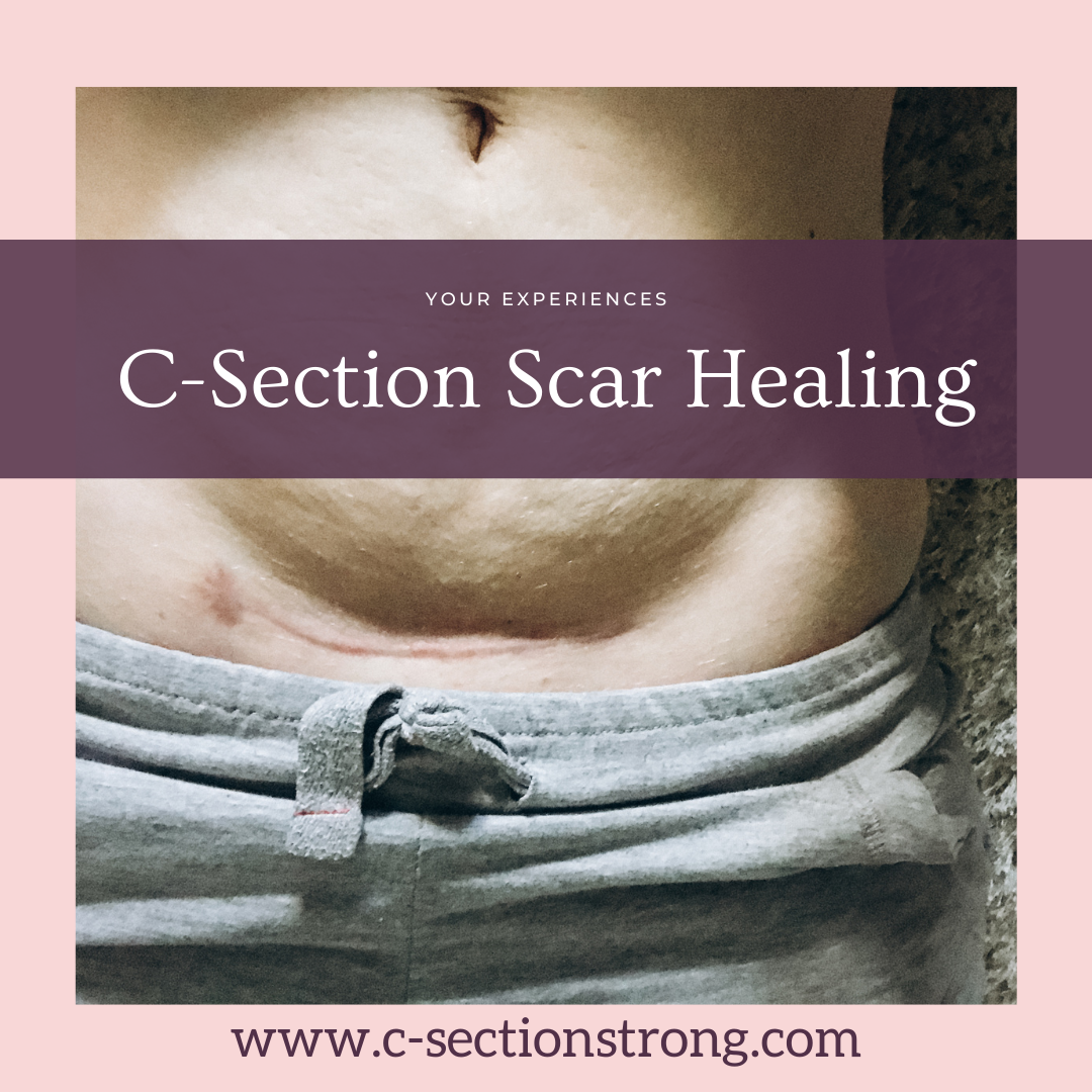 Cesarean Scar Healing - Personal Experiences