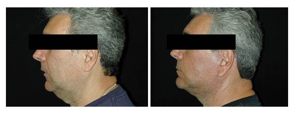 Chin Augmentation Philadelphia