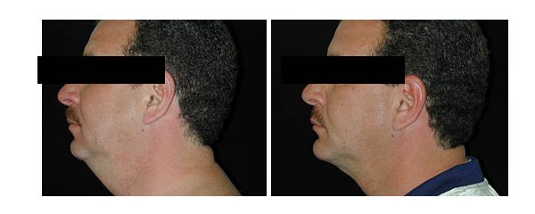 Chin Augmentation Surgery Delaware