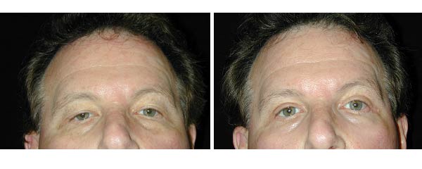 Eyelid Surgery