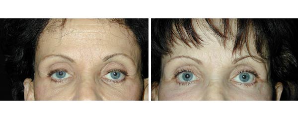 Upper Eyelid Surgery