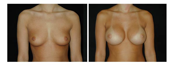 breastaugmentation01.jpg