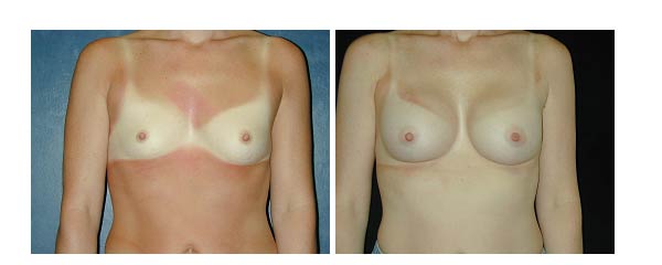 breastaugmentation02.jpg