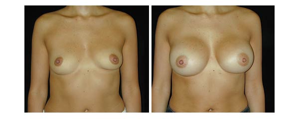 breastaugmentation03.jpg