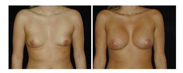 breastaugmentation04.jpg