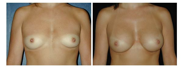 breastaugmentation08.jpg