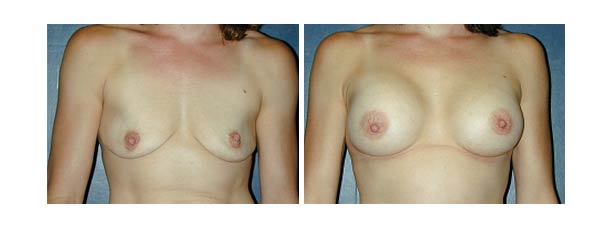 breastaugmentation09.jpg