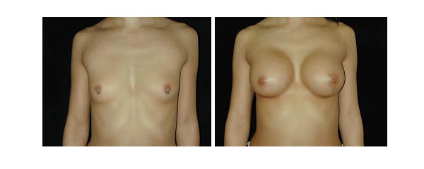 breastaugmentation10.jpg