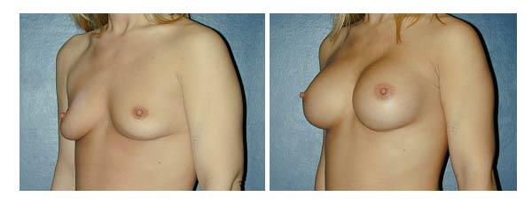 breastaugmentation12.jpg