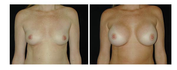 breastaugmentation13.jpg