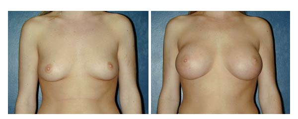 breastaugmentation14.jpg