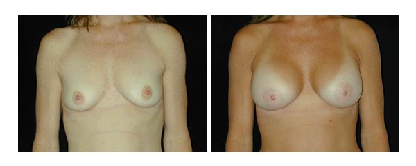 breastaugmentation15.jpg