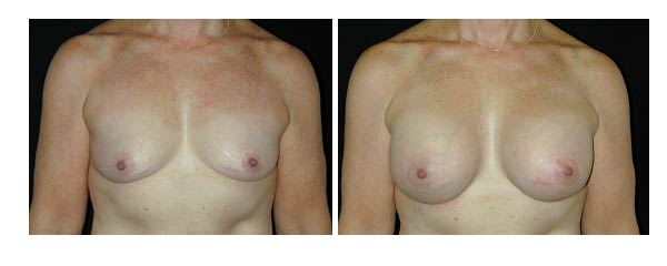 breastaugmentation16.jpg