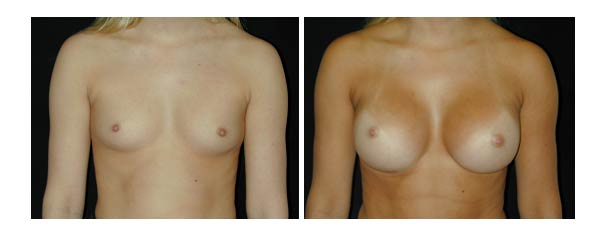 breastaugmentation17.jpg