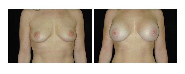 breastaugmentation22.jpg