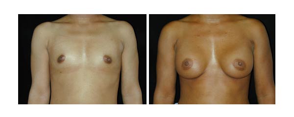 breastaugmentation23.jpg