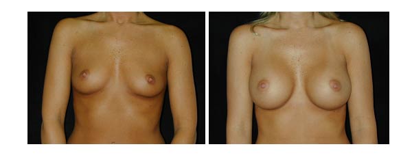 breastaugmentation24.jpg