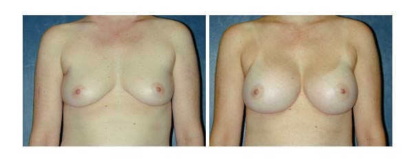 breastaugmentation26.jpg