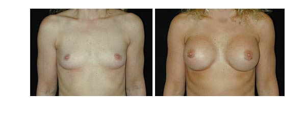 breastaugmentation27.jpg