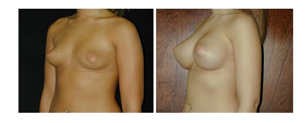 breastaugmentation29.jpg